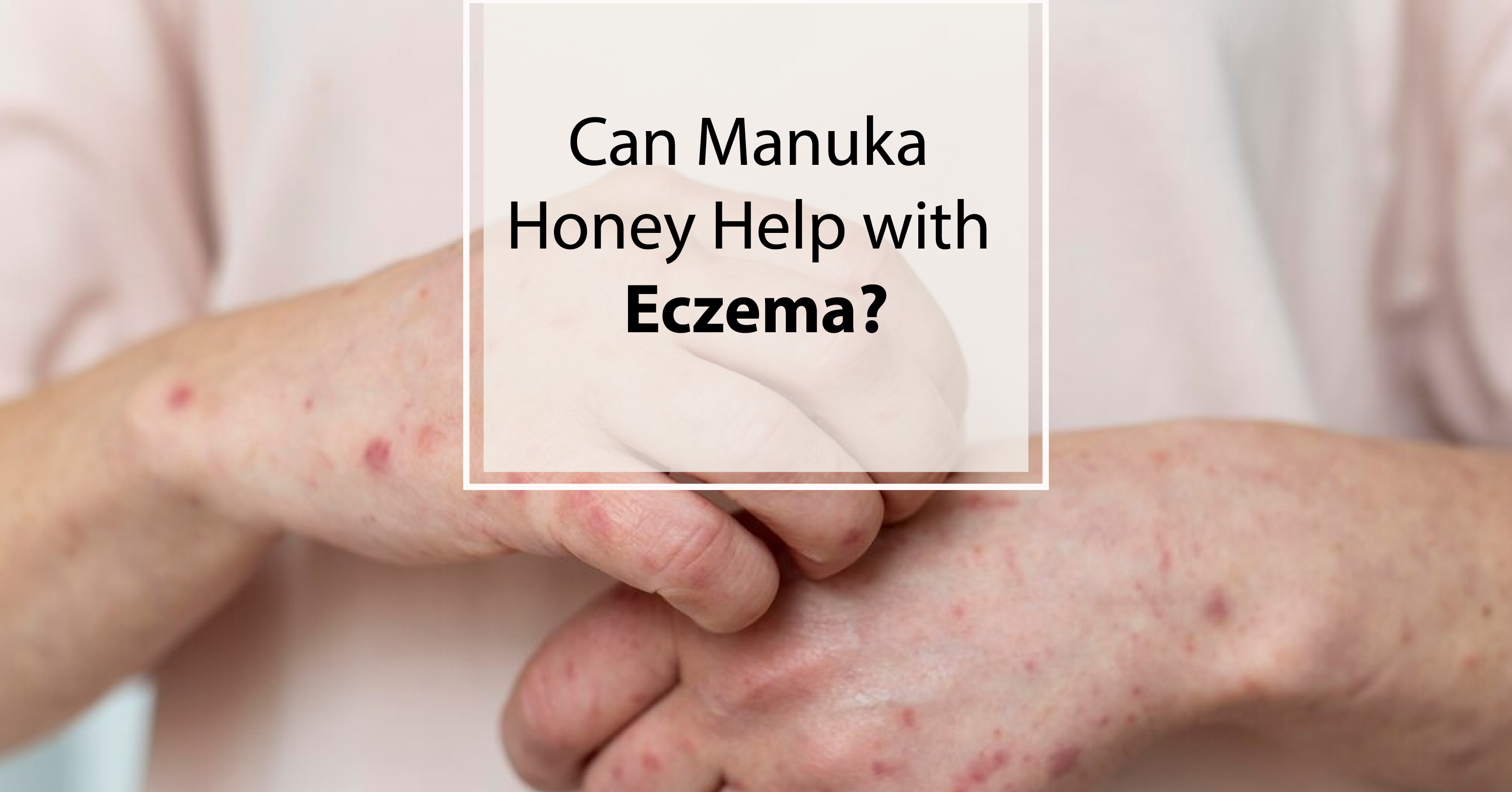 The image focuses on a close-up view of two hands, one adult and one smaller, likely a child's, clasped together. Both hands exhibit visible signs of eczema, characterized by patches of red, inflamed, and irritated skin. The skin appears dry, flaky, and slightly bumpy, with areas of redness extending across the backs of the hands and fingers. The texture suggests significant discomfort and potential itchiness. The adult hand is gently holding the child’s hand, possibly offering comfort or support. The background is a soft, blurred pale pink or peach color, creating a gentle and somewhat clinical aesthetic. Superimposed over the image, within a white rectangular frame with a thin border, is text that reads