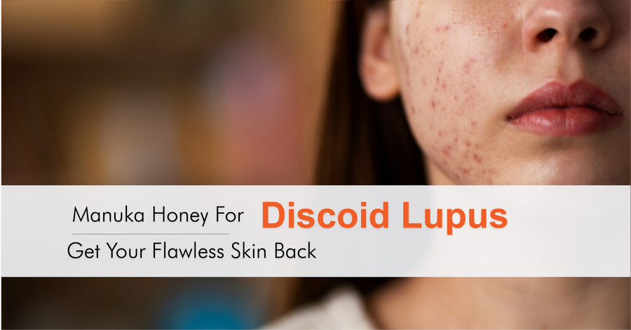 Manuka Honey for Discoid Lupus: Get Your Flawless Skin Back
