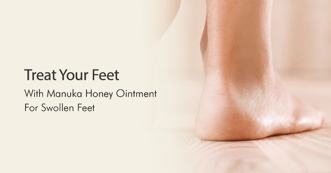 Treat Your Feet with Manuka Honey Ointment for Swollen Feet