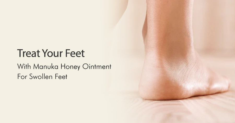 Treat Your Feet with Manuka Honey Ointment for Swollen Feet
