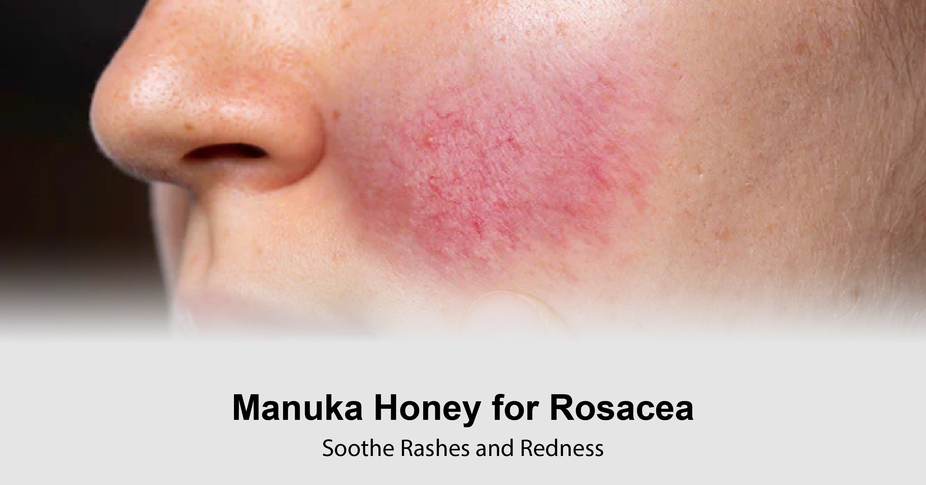 Honey Looking Rash Manuka Honey for Rosacea: Soothe Rashes and Redness